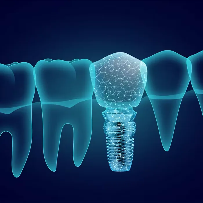 Illustration of a dental implant anchored in the jawbone beside natural teeth