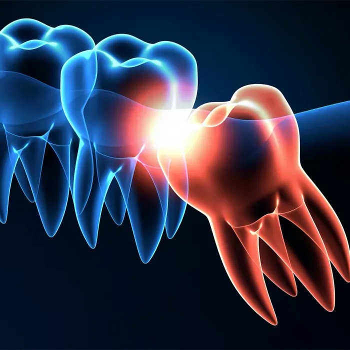Illustration of an impacted wisdom tooth beside healthy teeth